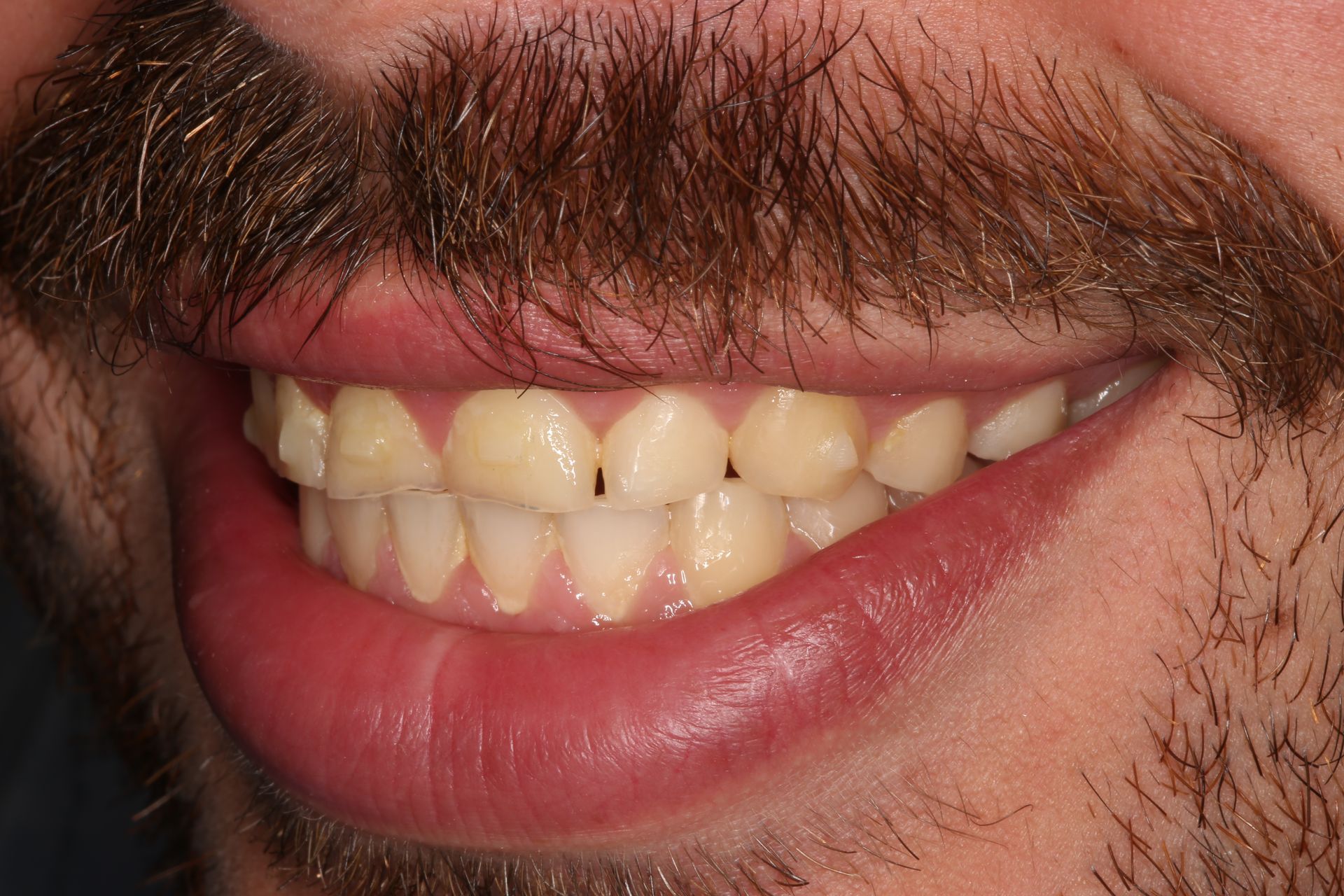 Close-up of a person's mouth and mustache, showing teeth and a slight smile.