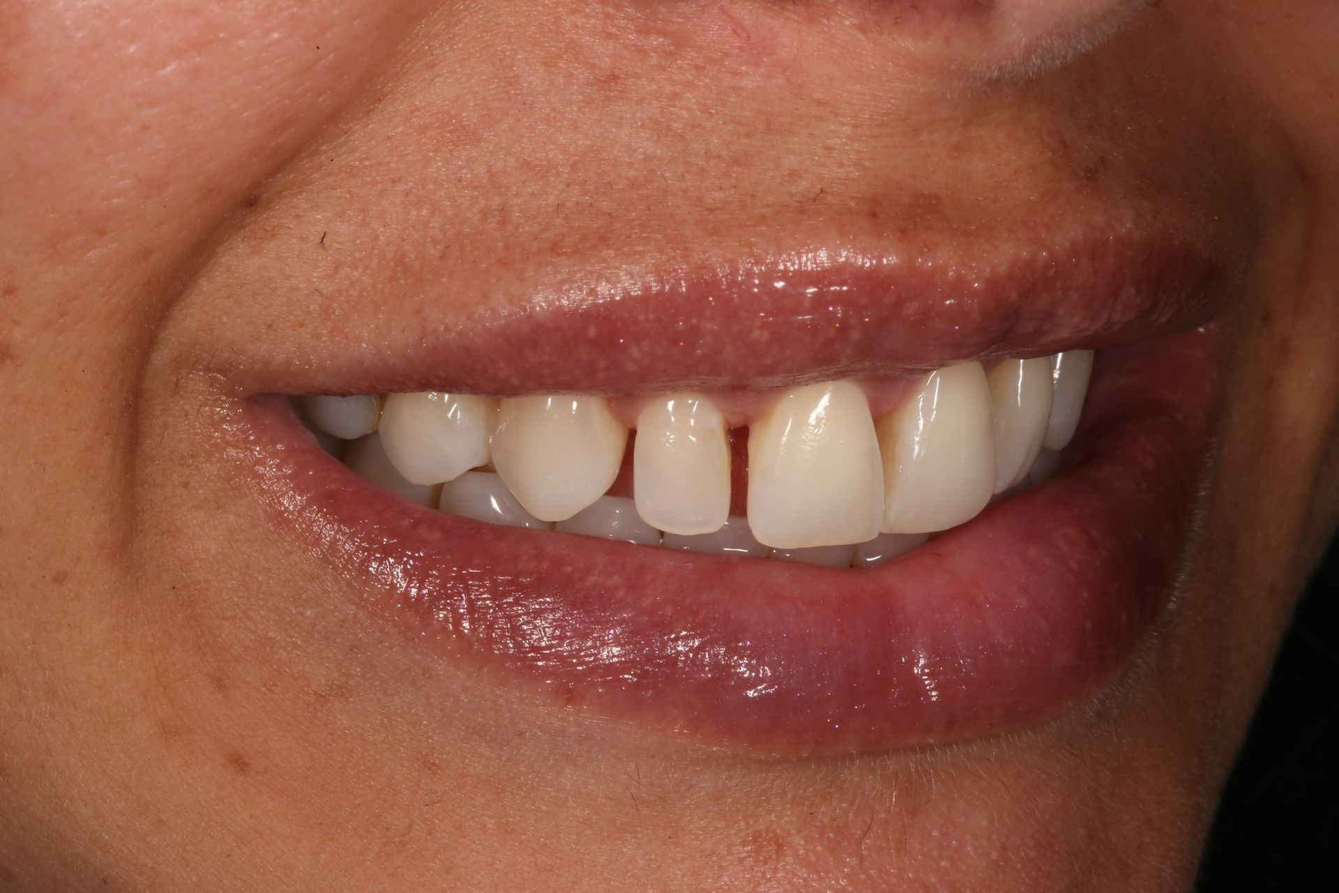 Close-up of a person's smile, highlighting a small gap between the two front teeth.