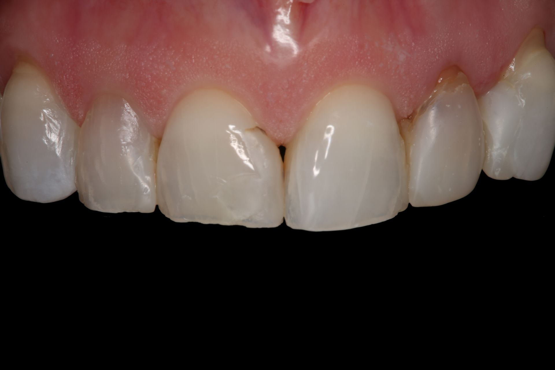 A close-up view of a person's upper front teeth showing dental restorations and minor chips on the enamel.