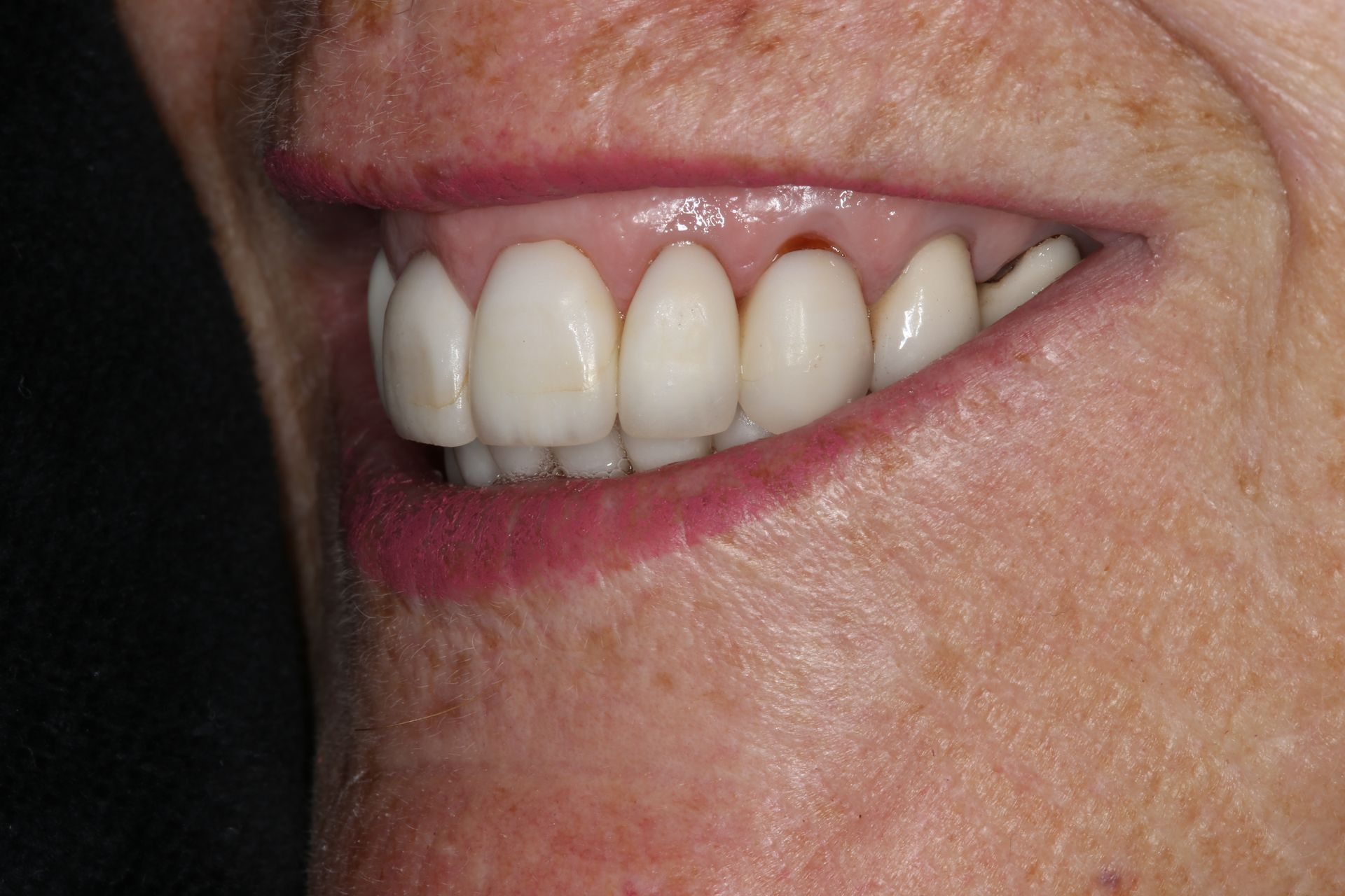 Close-up of a person's side profile, showing dental crowns and a visible gap at the gumline of the upper lateral incisor.
