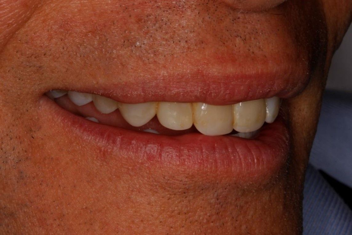 A close-up view of a person’s lower face, showing natural-looking teeth and lips while smiling slightly.