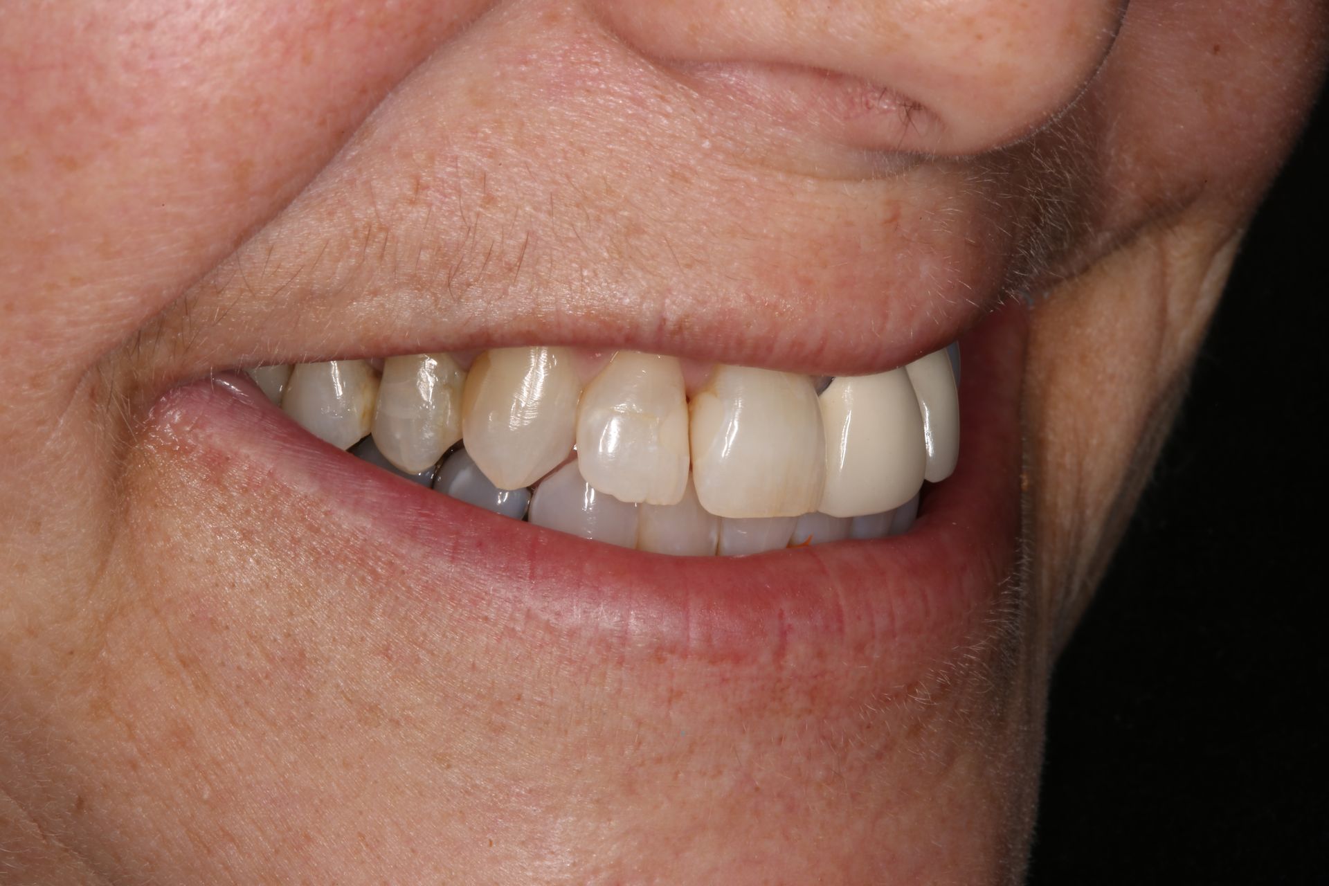 A close-up view of a person’s lower face, showing a smile with teeth that vary in shade and color.
