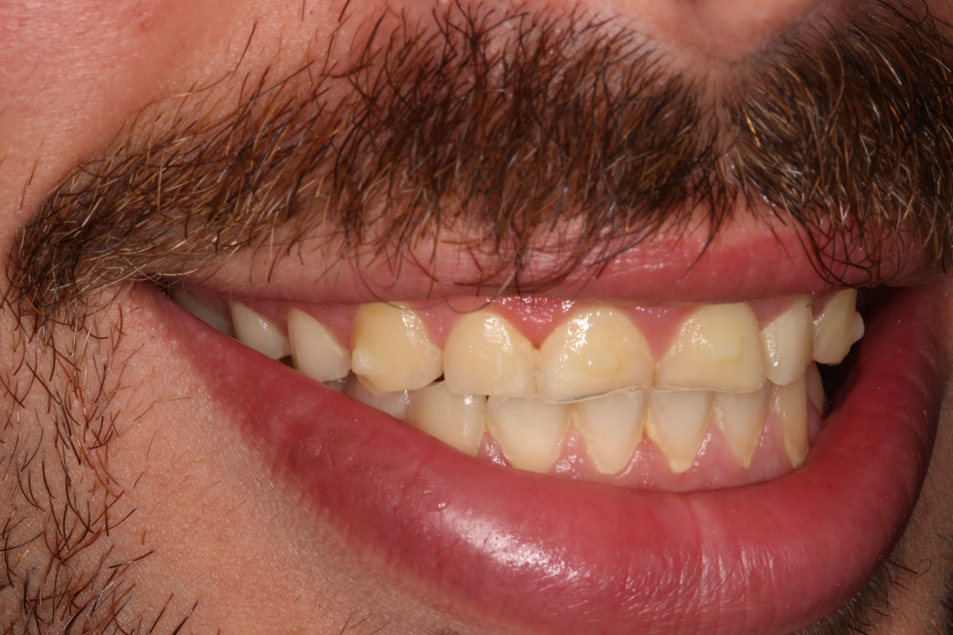 A close-up of a person's mouth and mustache, showing yellowed teeth and a slight smile.