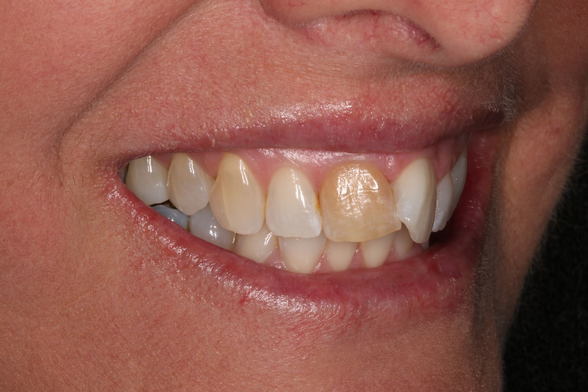 Close-up of a person's smiling mouth, showing a discolored front tooth compared to the surrounding natural teeth.