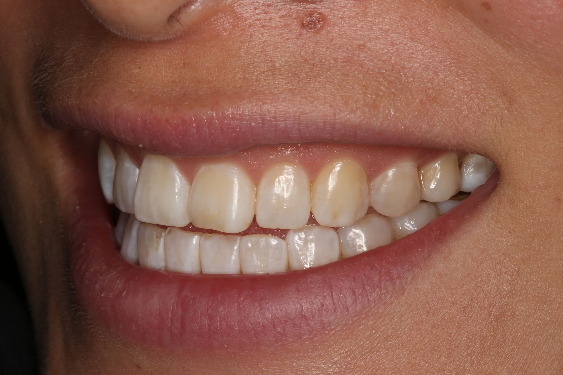 A close-up view of a smiling mouth, showing natural, off-white upper and lower teeth.