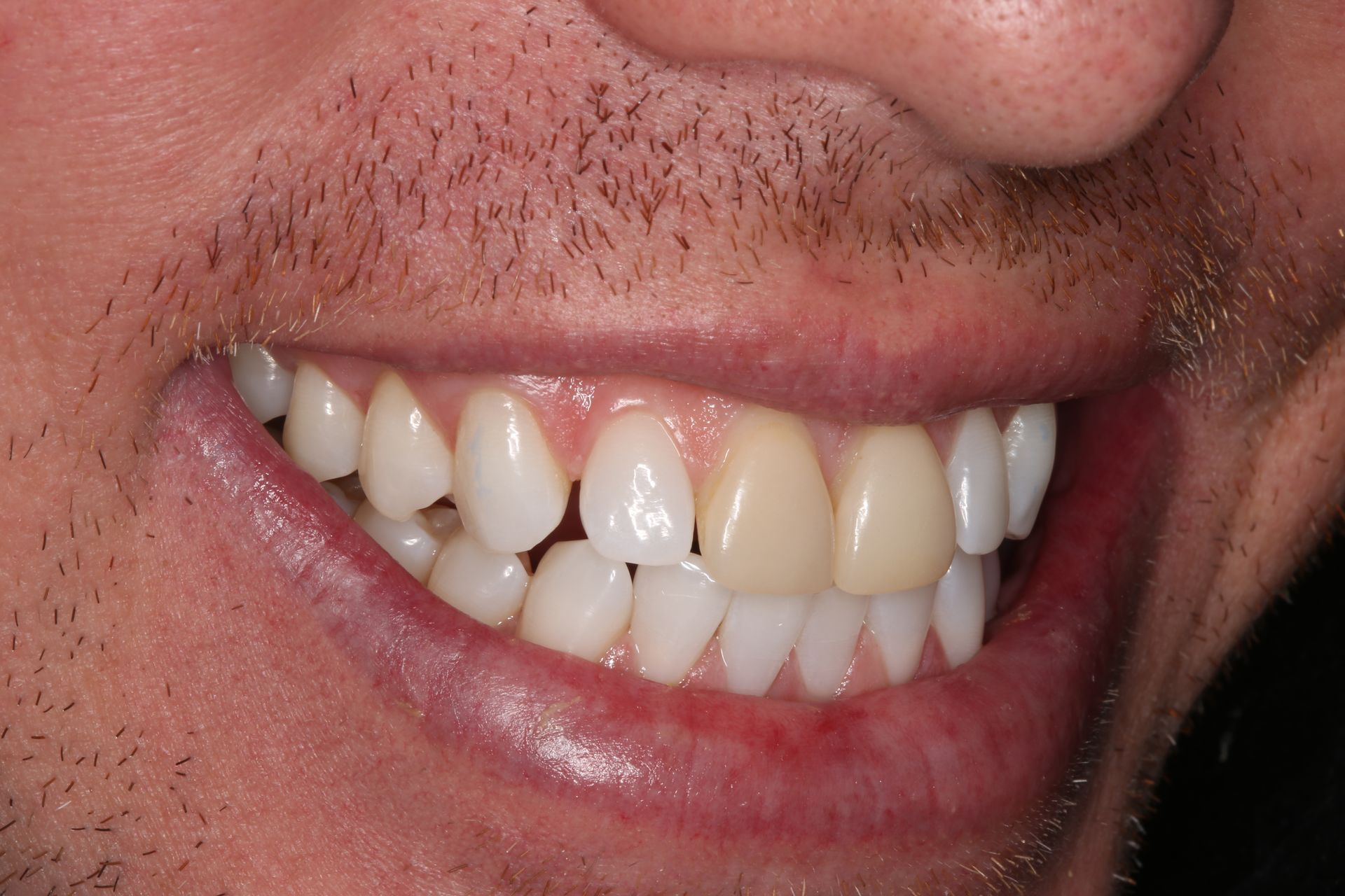 A close-up of a person's smile, showing a significant color mismatch between two adjacent central incisor teeth.