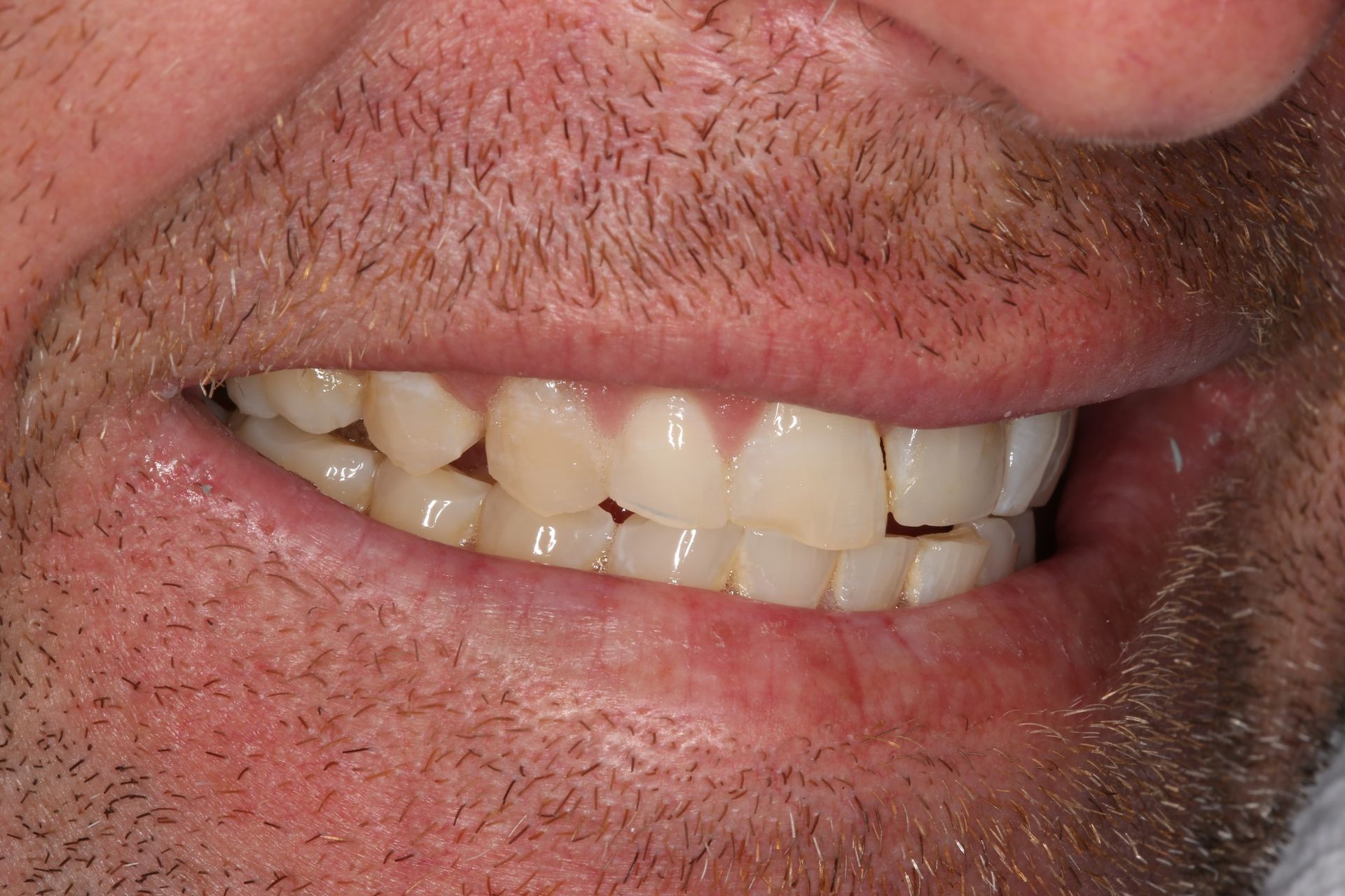 Close-up of a person's mouth showing slightly misaligned upper teeth.