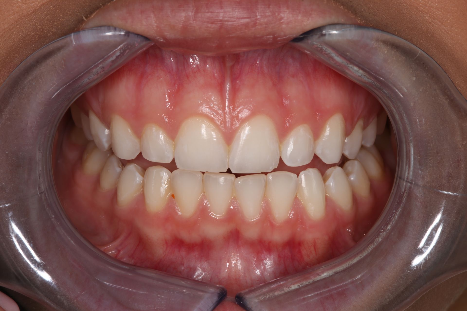 Close-up of a person's teeth and gums held open by a plastic dental retractor.