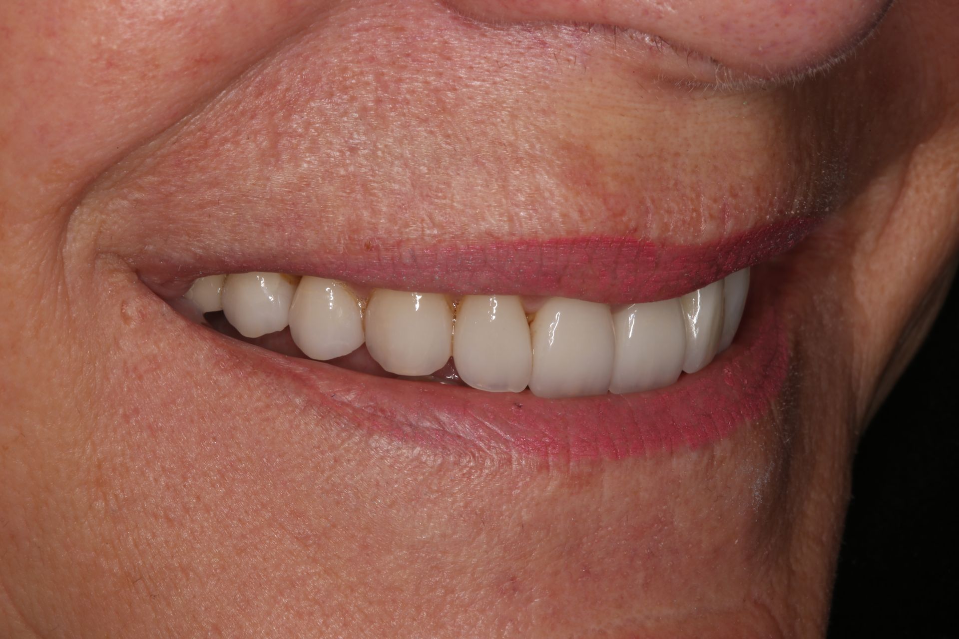A close-up view of a smiling mouth showing a set of clean, white, and well-aligned teeth.