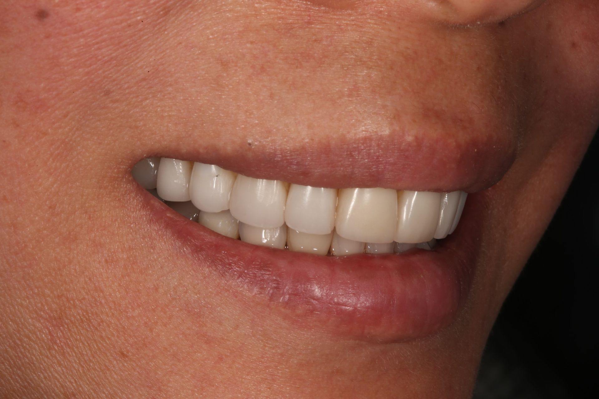 A close-up view of a person’s smile showing well-aligned, bright white upper teeth.