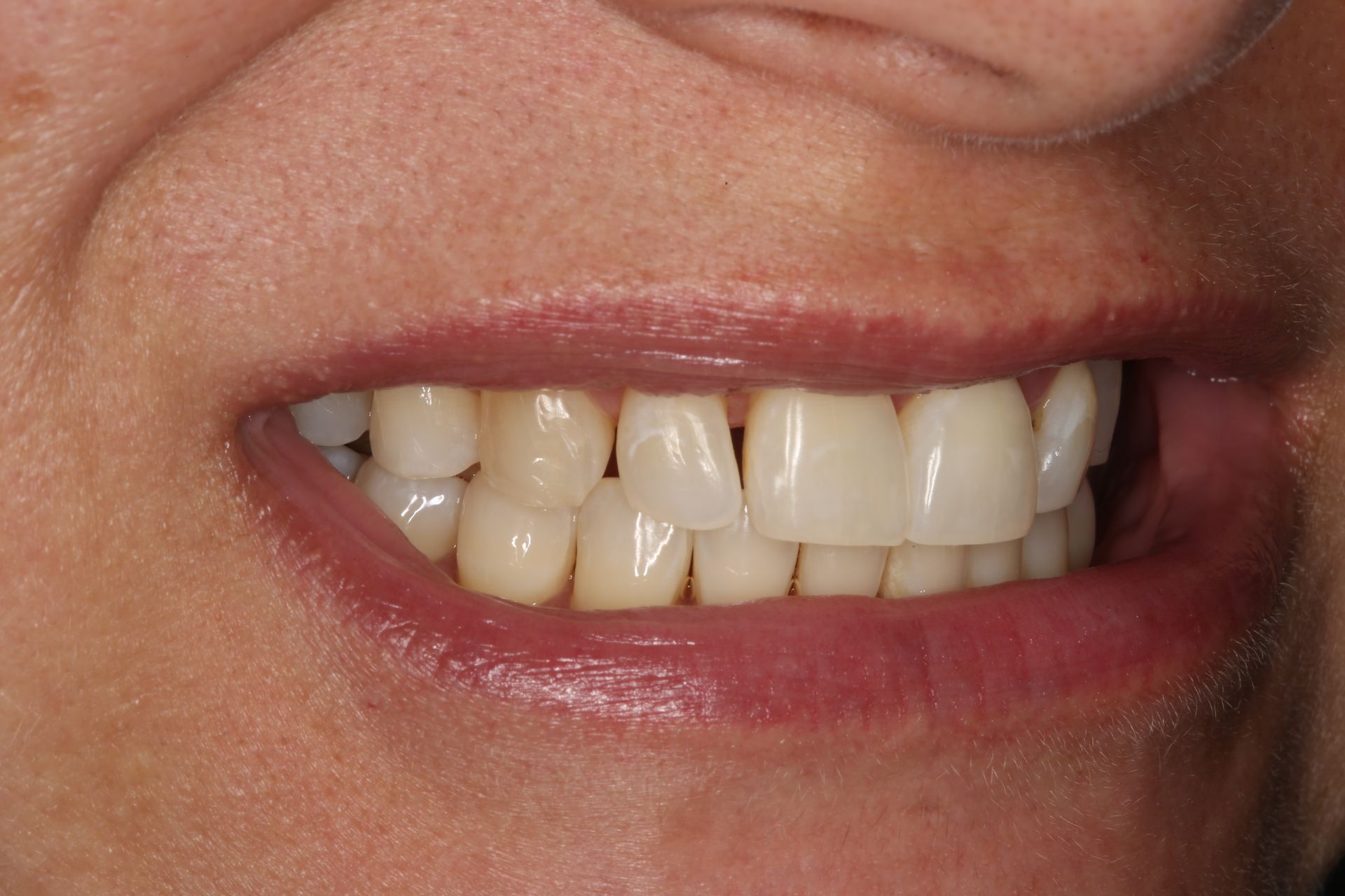A close-up view of a person smiling, showing the arrangement and condition of their upper and lower teeth.