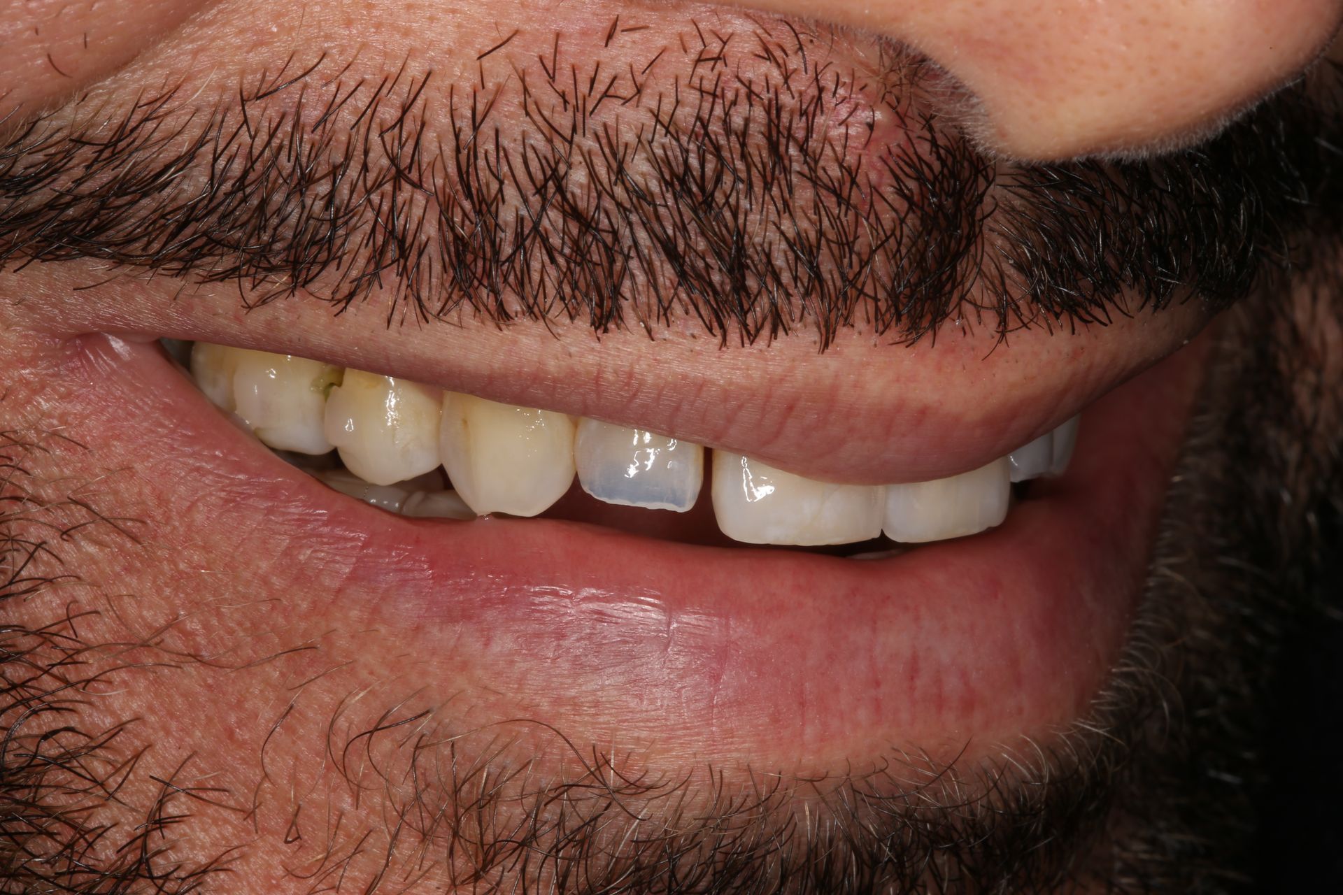 A close-up of a person's mouth showing slight chips and aesthetic irregularities on the upper front teeth.