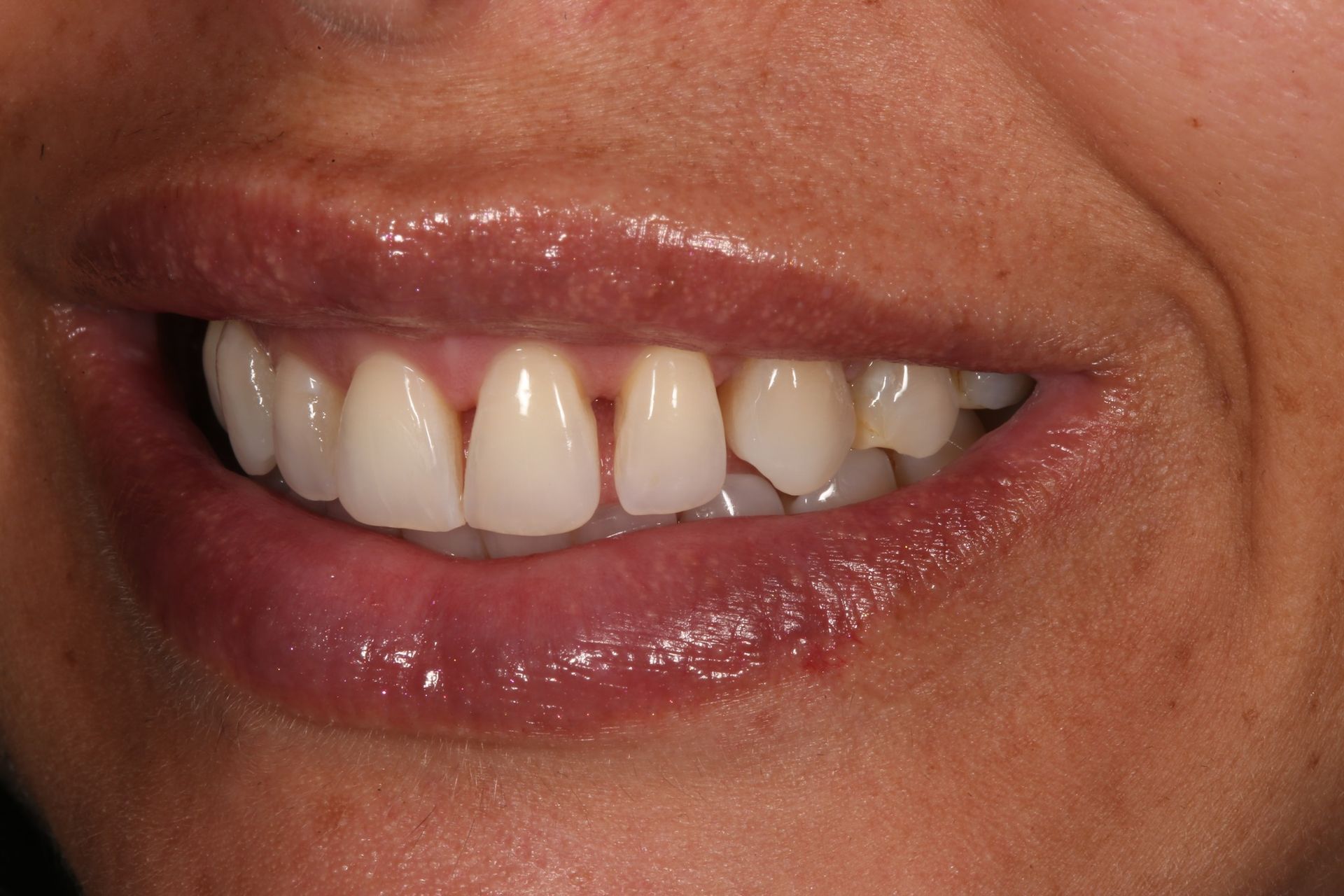 A close-up of a person's mouth in a gentle smile, highlighting the alignment and condition of the upper front teeth.