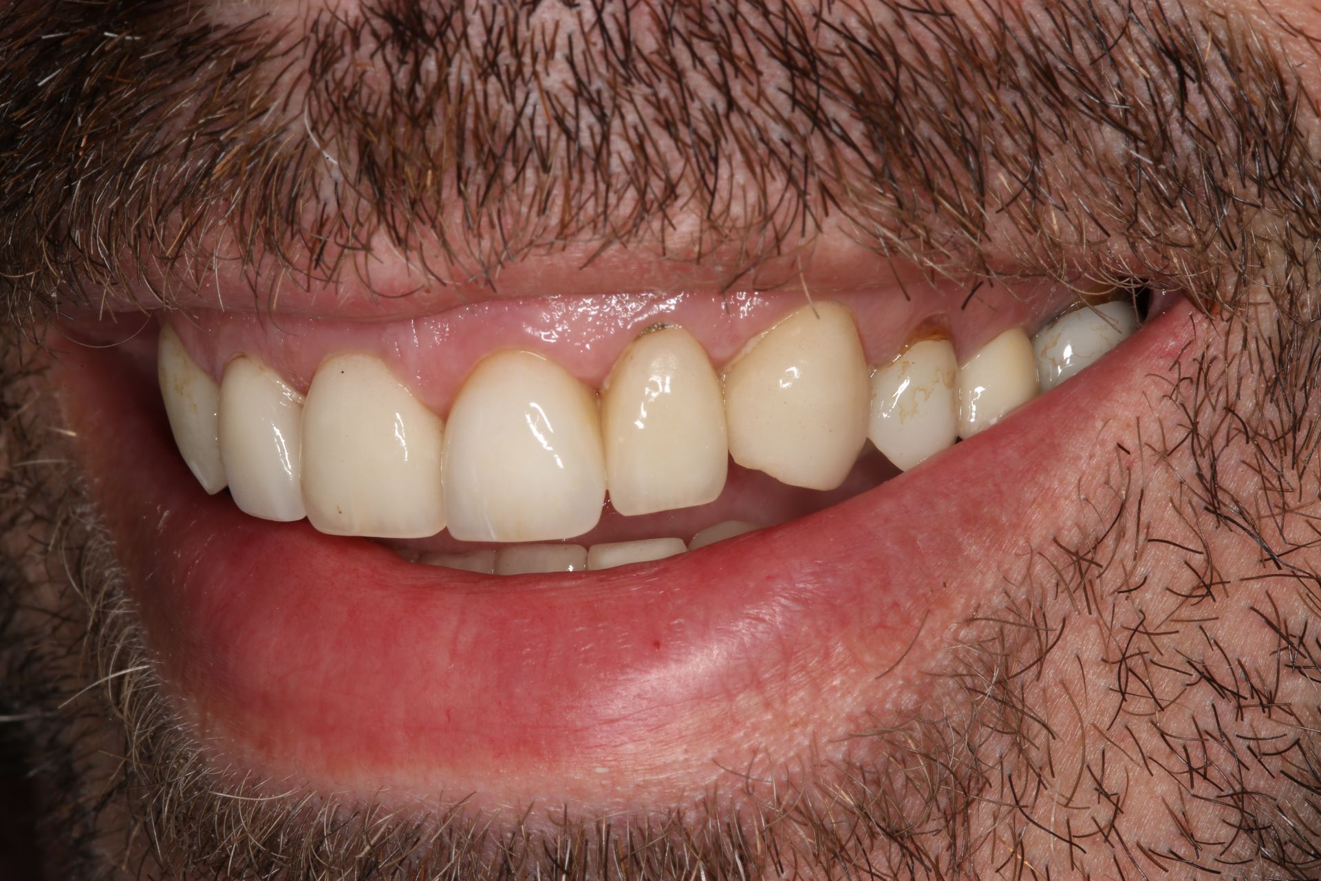 A close-up view of a smiling mouth showing a set of natural-looking teeth and a bearded jawline.