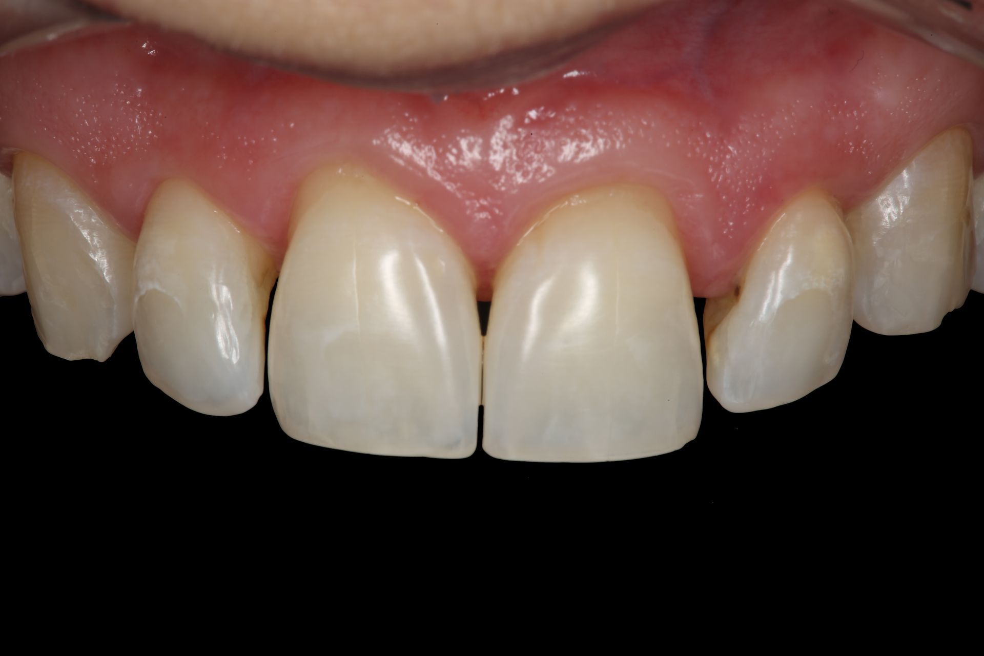 Close-up of a person's upper front teeth and healthy gums against a black background.
