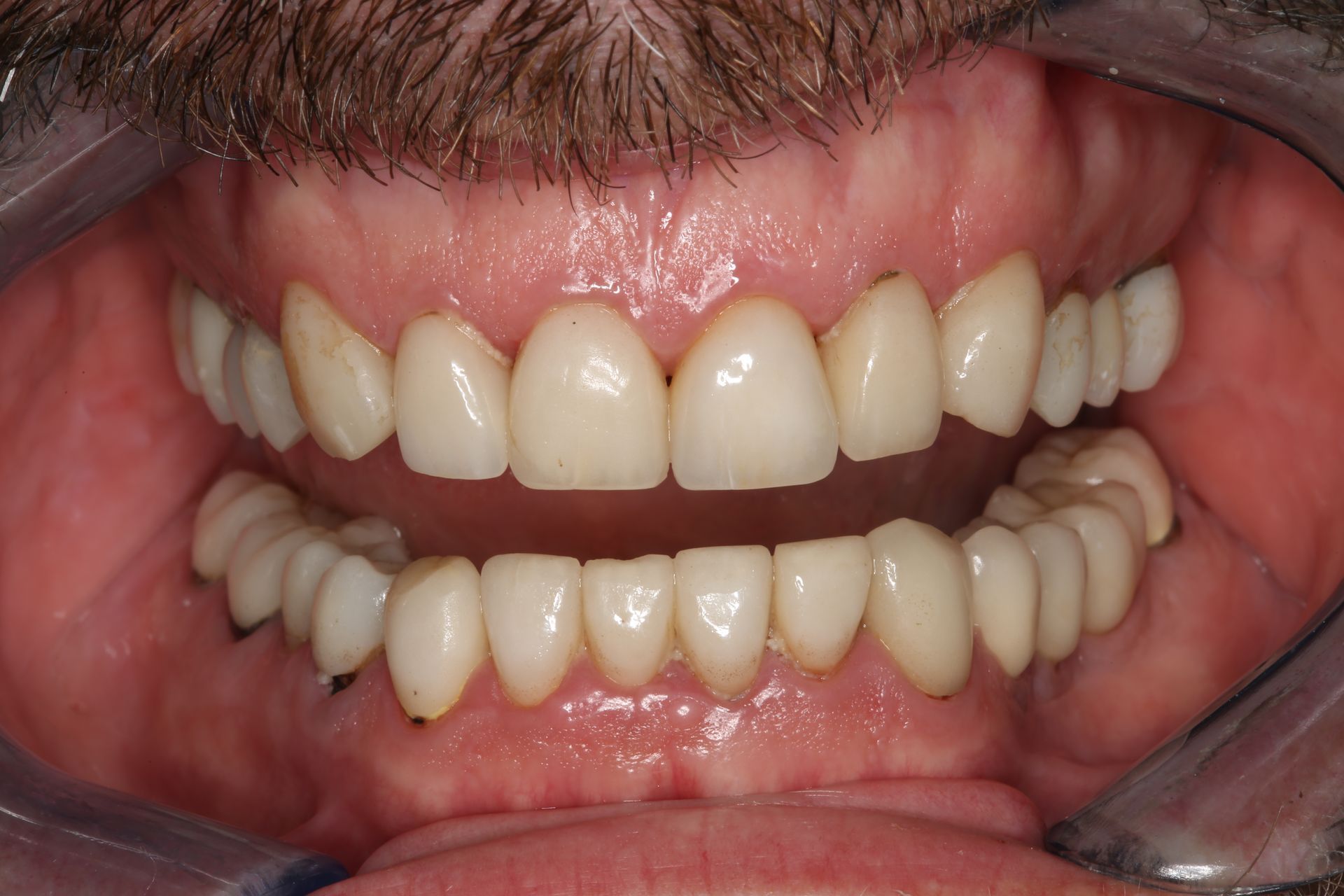 A close-up of a person's mouth with a full set of dental crowns or veneers, showing aligned white teeth and pink gums.