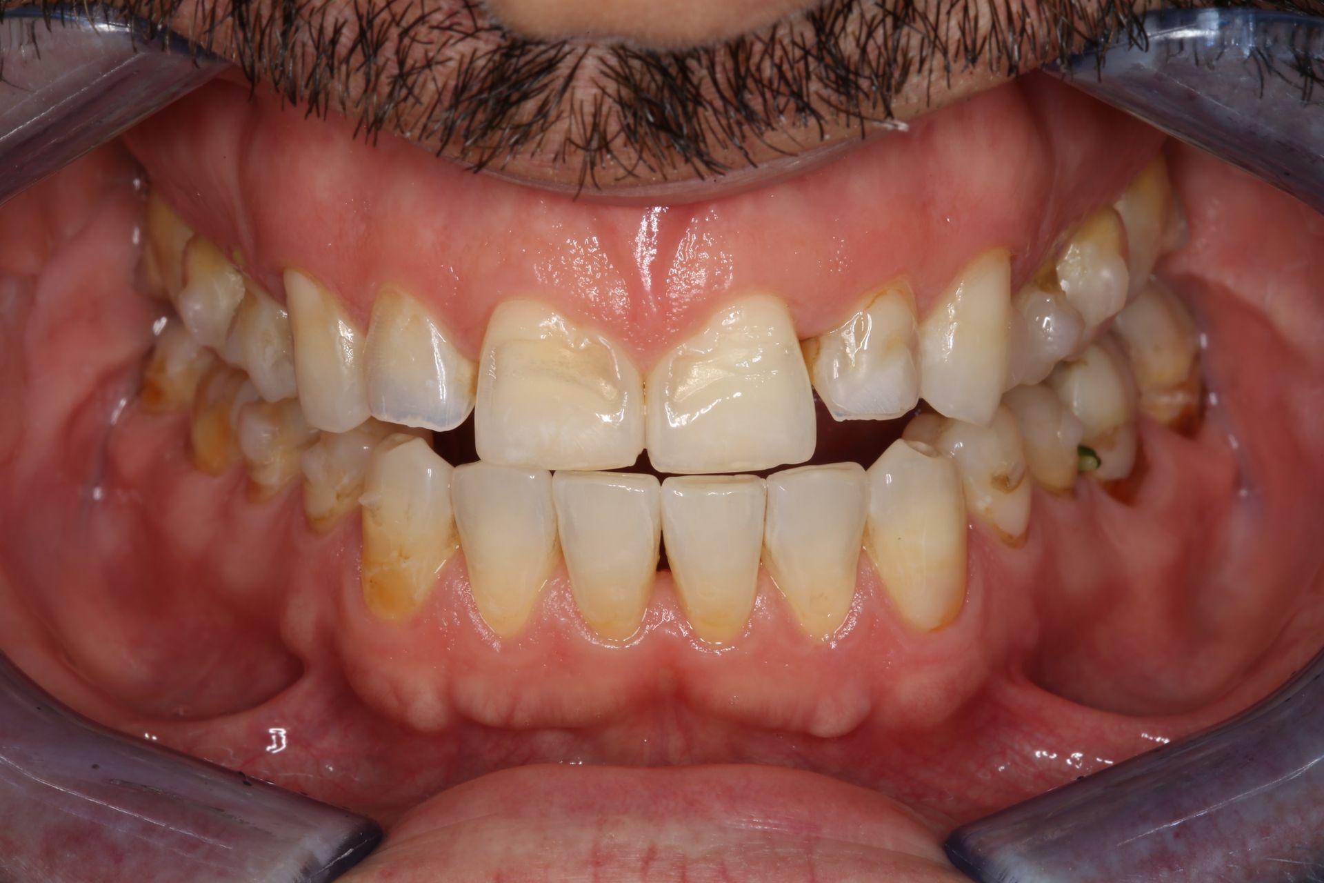 A close-up of a person's teeth and gums, showing slightly crowded lower teeth and general dental alignment.