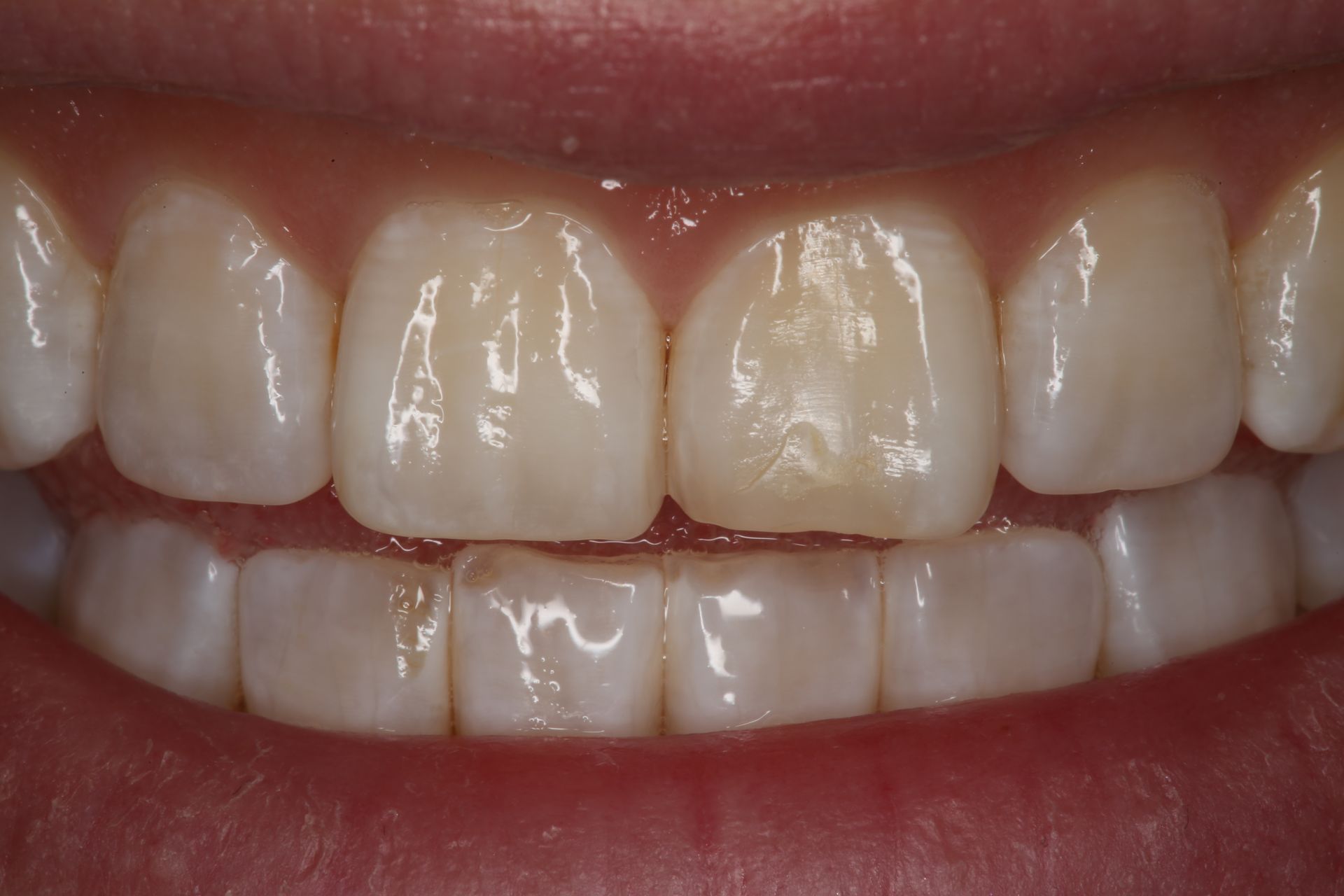 Close-up of a person's upper and lower teeth showing mild wear on the edges of the two front teeth.
