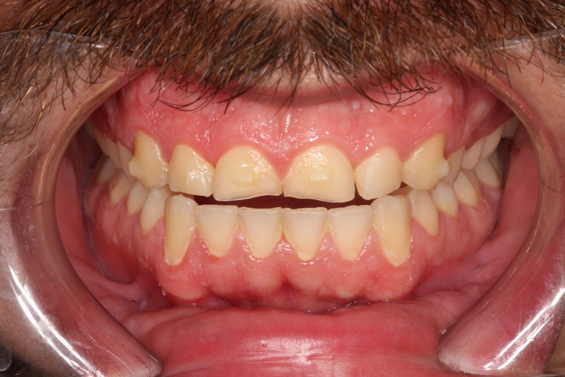 A close-up view of an open mouth showing upper and lower teeth, with healthy pink gums and a slight open bite.