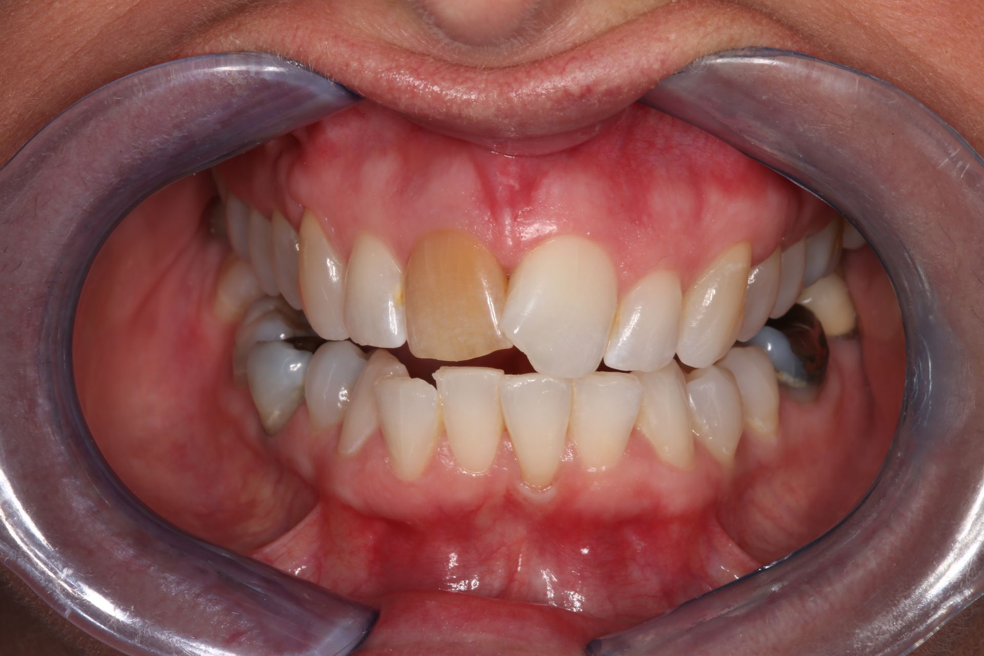 An open mouth showing teeth, with a single upper front incisor noticeably discolored with a yellowish-brown tint.