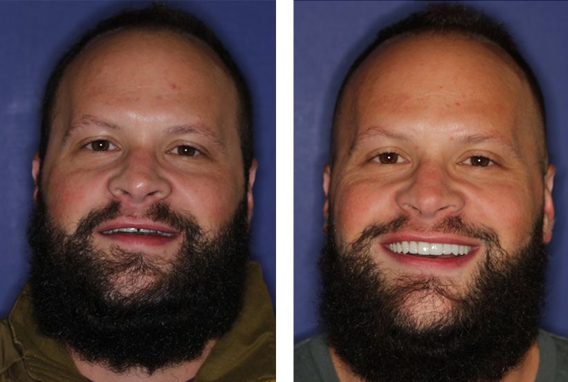 Before and after comparison of a person showing a significant improvement in their smile after dental treatment.