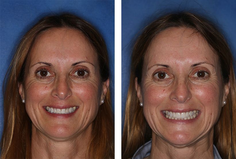 Before-and-after comparison showing a woman's smile before and after dental treatment, featuring whiter, aligned teeth.