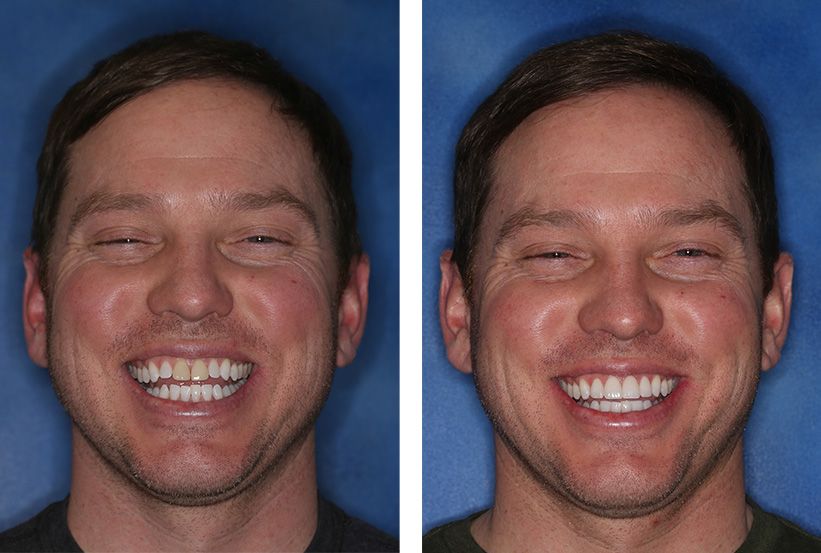 Before and after comparison of a person's smile, showing whiter, more uniform teeth following a dental procedure.