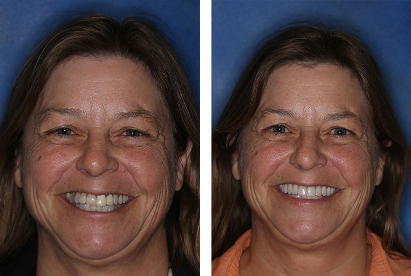 A before-and-after comparison of a person smiling, showing a dental restoration on their upper teeth.