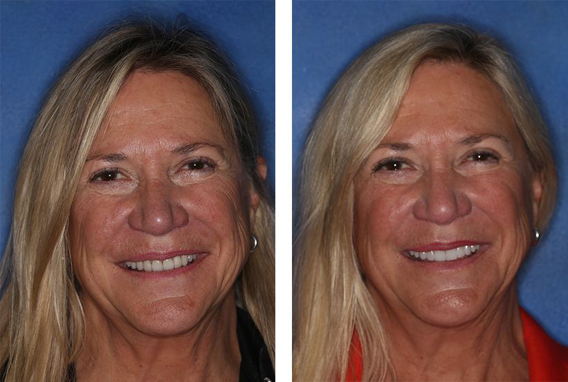 Before-and-after comparison showing a person's facial profile and smile after a cosmetic dental or aesthetic procedure.