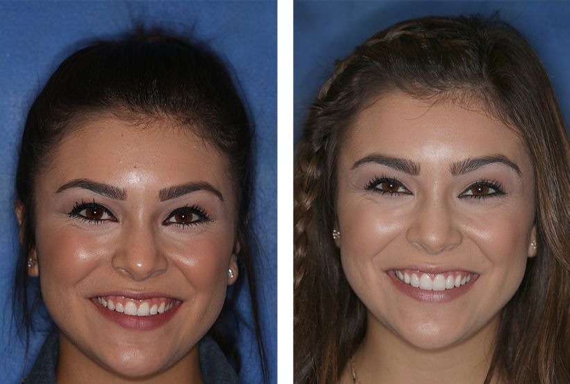 Before and after comparison of a woman’s smile, showing teeth whitening and dental alignment against a blue background.