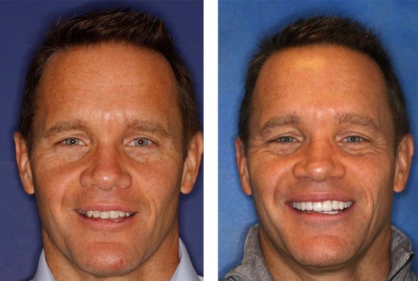 Before and after photos of a man’s smile, showing teeth whitening and dental restoration.