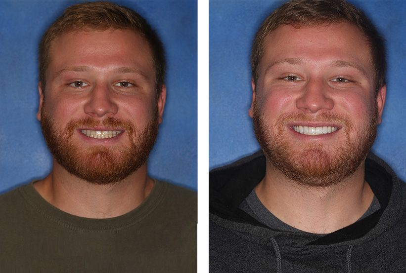 Before and after comparison of a man’s smile showing the results of dental treatment or teeth whitening.