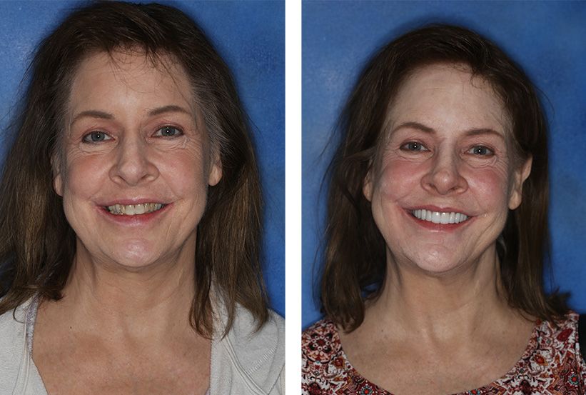 Before and after comparison of a person showing a dental procedure result, with a brighter, improved smile on the right.