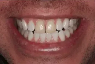 A close up of a man 's mouth with white teeth.