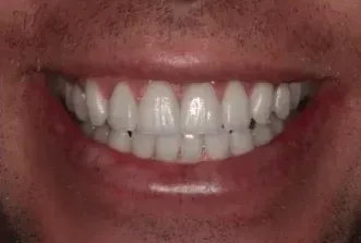 A close up of a man 's mouth with white teeth.