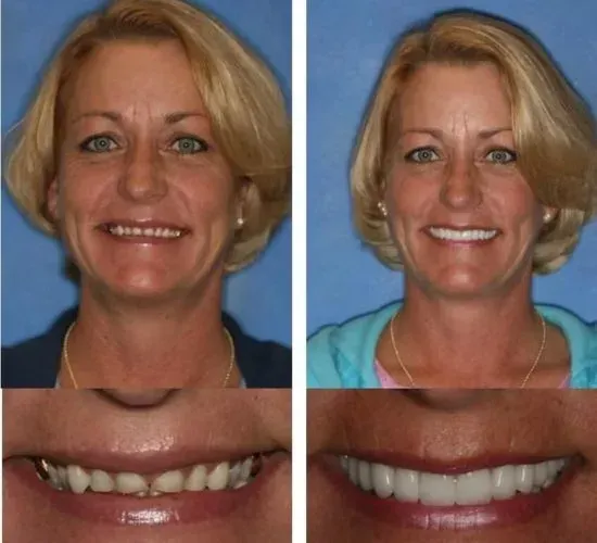 A before and after photo of a woman 's smile