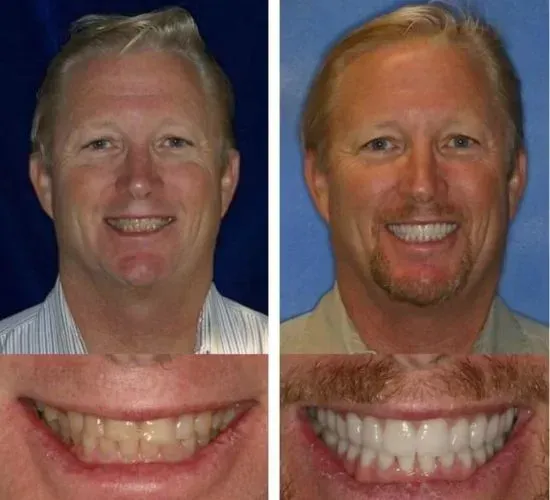 A before and after picture of a man 's smile