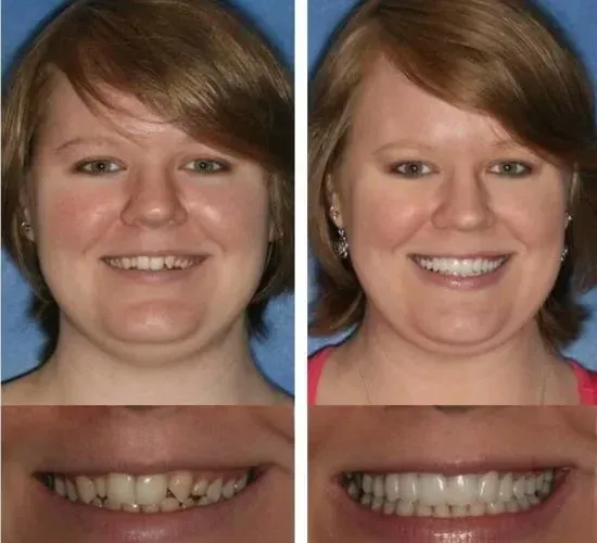 A before and after photo of a woman 's smile