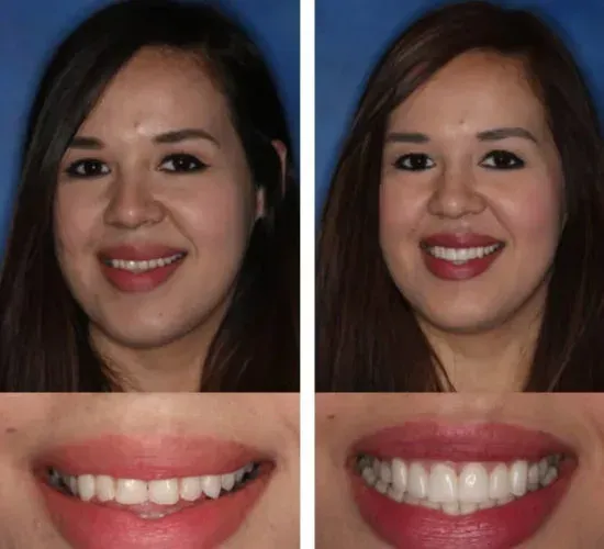 A before and after picture of a woman 's smile