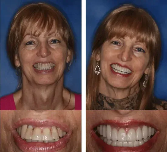 A before and after photo of a woman 's smile