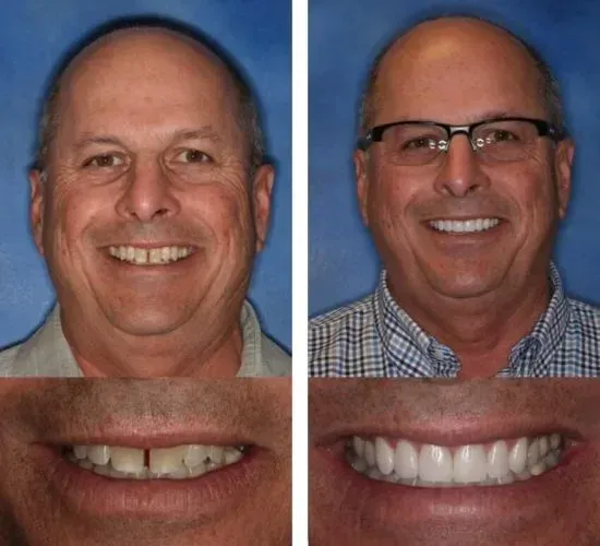 A before and after picture of a man 's smile