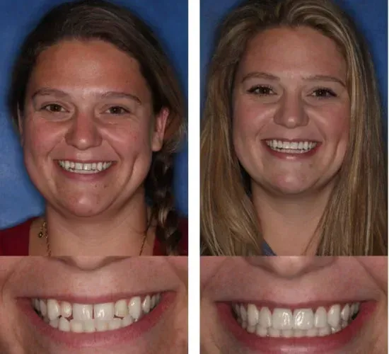 A before and after photo of a woman 's smile