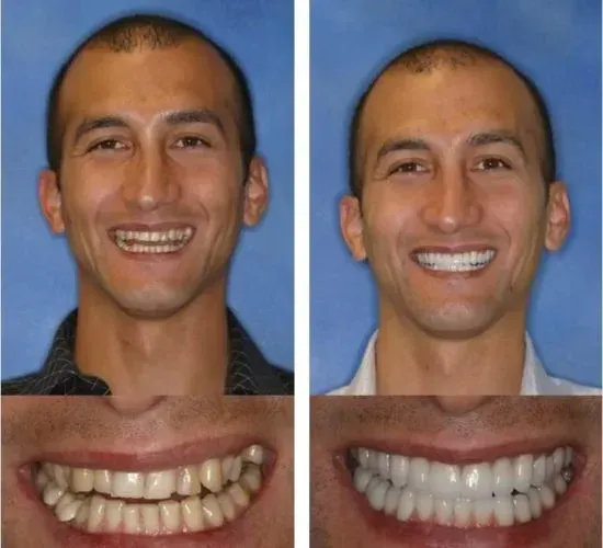 A before and after picture of a man 's smile