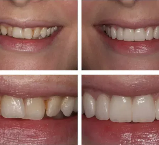 A collage of four pictures of a woman 's teeth before and after treatment