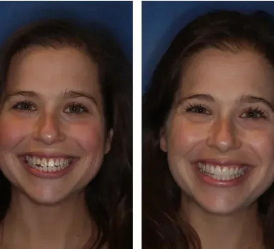 Two pictures of a woman smiling with her teeth showing