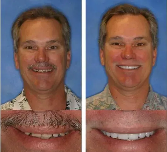 A before and after picture of a man 's smile