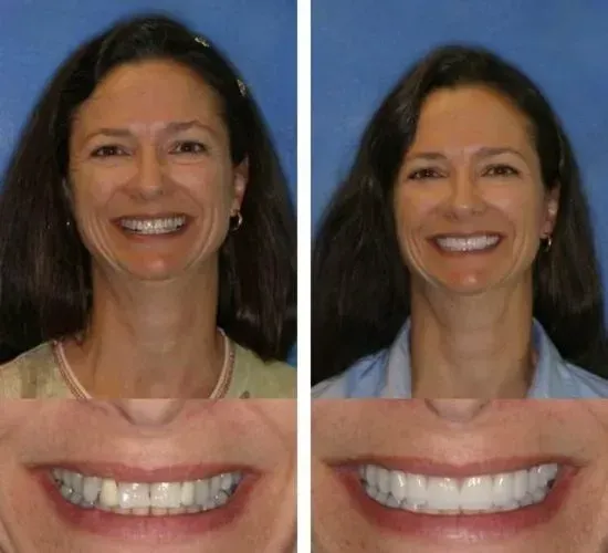 A before and after photo of a woman 's smile
