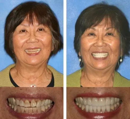A before and after photo of a woman 's smile