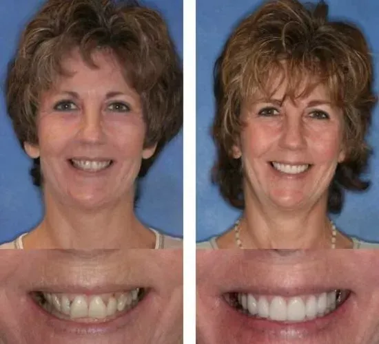 A before and after photo of a woman 's smile