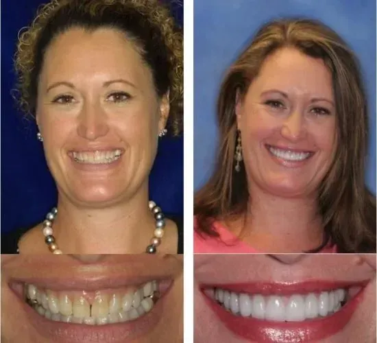 A before and after picture of a woman 's smile